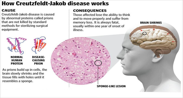 prion_disease.jpg